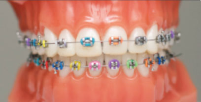 Types of Braces - Smile Design & Beyond, Los Angeles Orthodontist