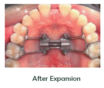 Palatal Expander - Village Orthodontics & Minneapolis Orthodontics